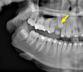 Impacted Canine Tooth