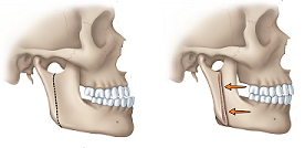 protruding lower jaw